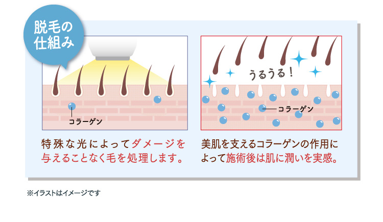 脱毛の仕組み 特殊な光によってダメージを与えることなく毛を処理します。 美肌を支えるコラーゲンの作用によって施術後は肌に潤いを実感。