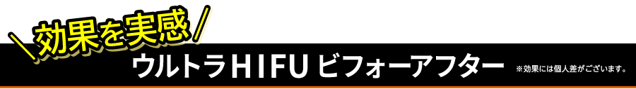 効果を実感　ウルトラHIFUビフォーアフター